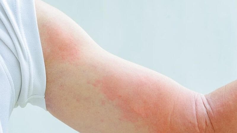 Những bệnh lý thường gặp khi trời nồm ẩm và cách phòng ngừa